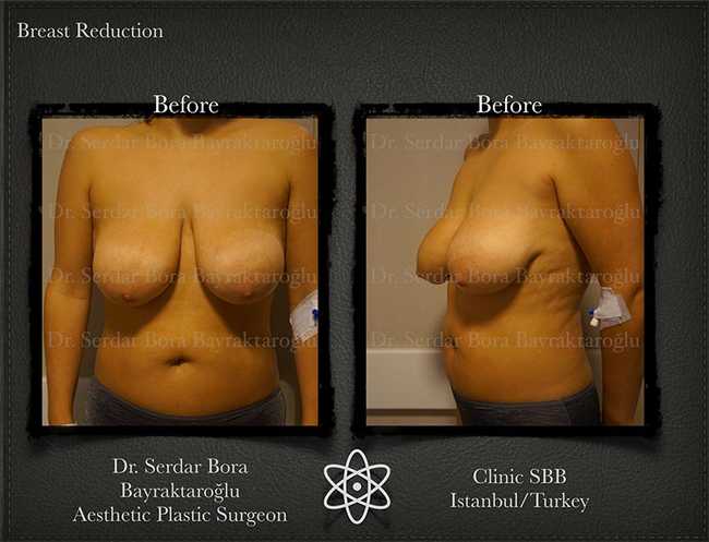 Breast Reduction Before After Serdar Bora Bayraktaroglu In Istanbul Clinic 13