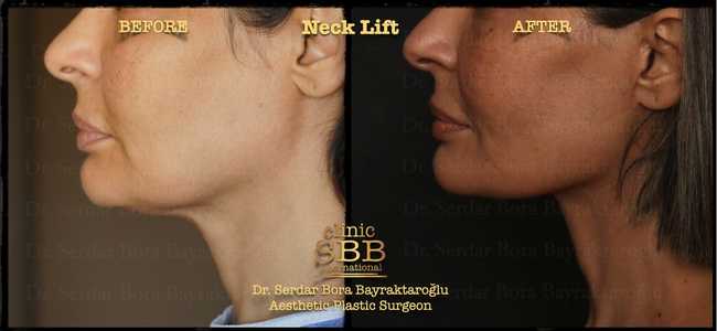 face neck lift before after 18