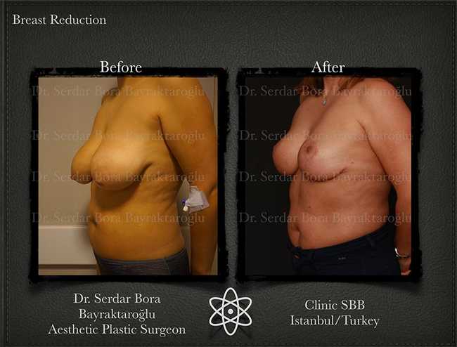 Breast Reduction Before After Serdar Bora Bayraktaroglu In Istanbul Clinic 15