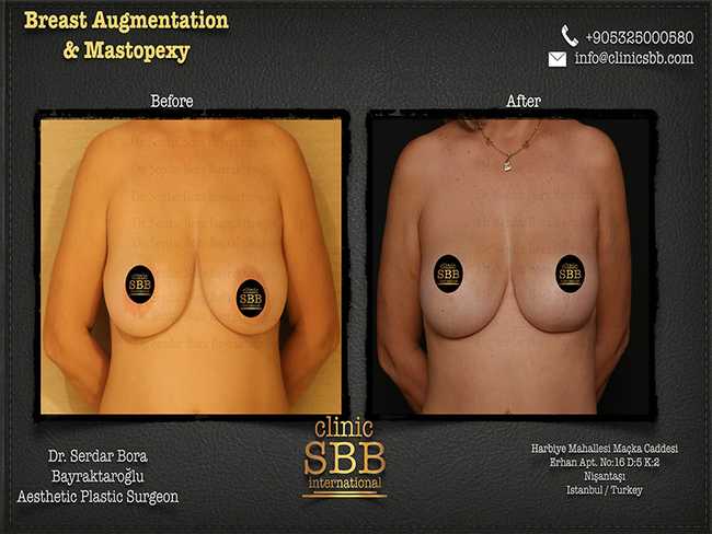 Breast Augmentation Mastopexy Clinic SBB Serdar Bora Bayraktaroglu 12