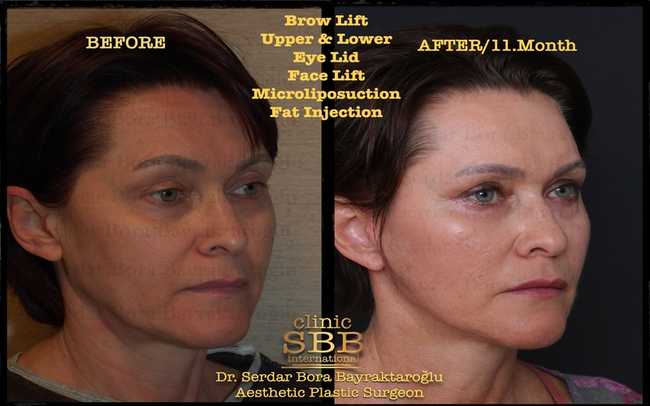 face neck lift before after 8