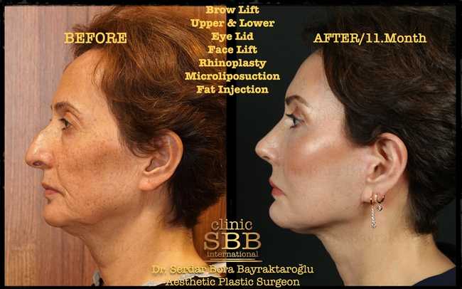 face neck lift before after 3