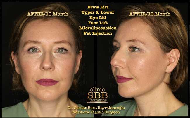 face neck lift before after 15