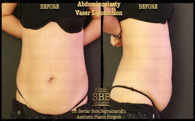 abdominoplasty before after 6