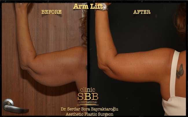 arm leg lift before after 4