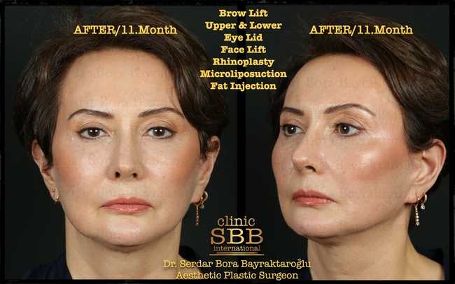 face neck lift before after 5