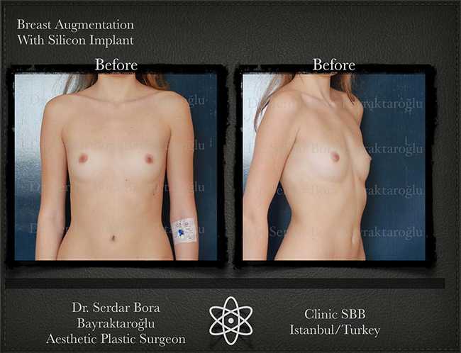 Breast Augmentation Before After Serdar Bora Bayraktaroglu In Istanbul Clinic 1 1