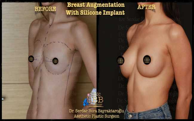 breast augmentation before after 7
