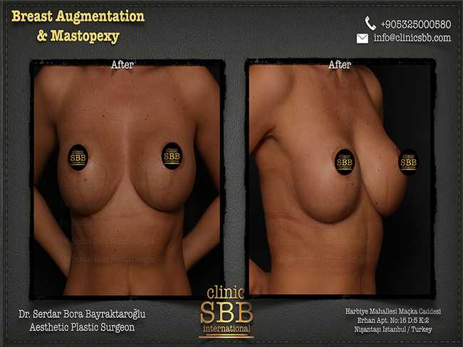 Breast Augmentation Mastopexy Clinic SBB Serdar Bora Bayraktaroglu 5