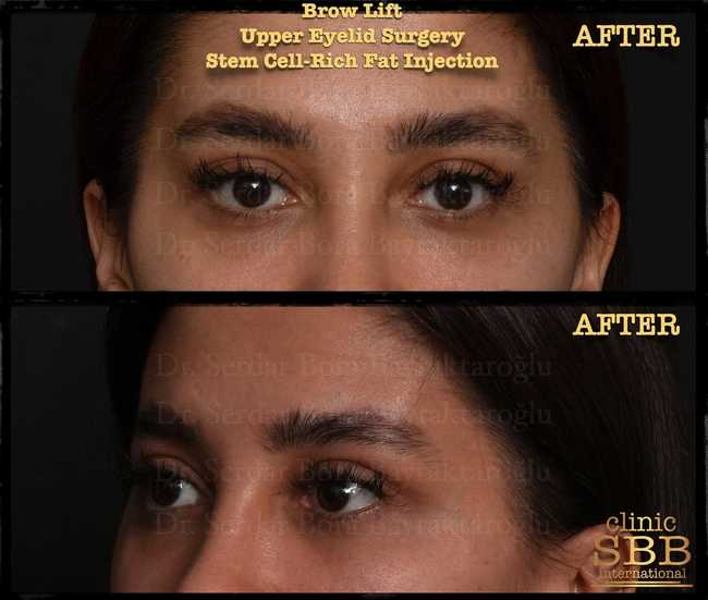eyebrown lift before after 10