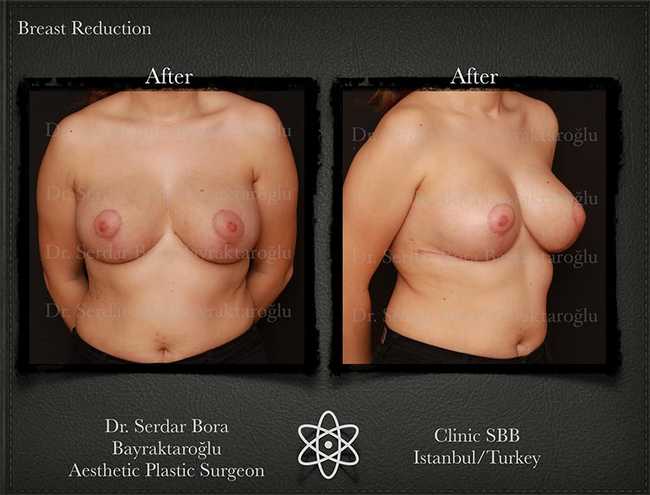 Breast Reduction Before After Serdar Bora Bayraktaroglu In Istanbul Clinic 12
